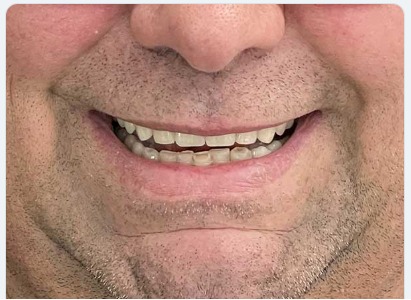 Sorriso dopo il trattamento