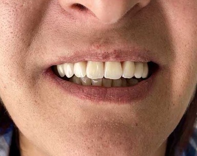 Sorriso dopo il trattamento