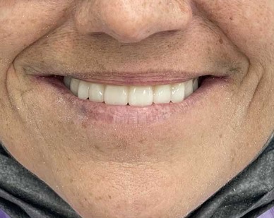 Sorriso dopo il trattamento