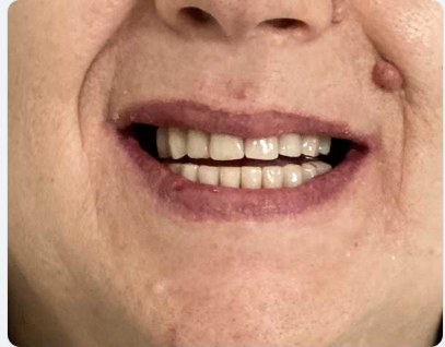 Sorriso dopo il trattamento