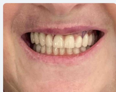 Sorriso dopo il trattamento