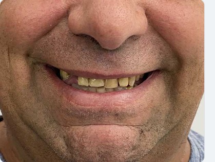 Sorriso prima del trattamento