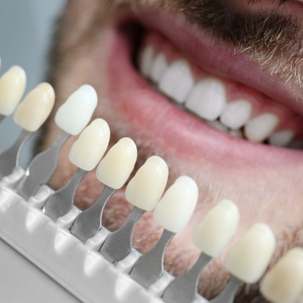 Faccette estetiche e servizio di urgenza